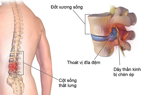 Chữa bệnh Thoát vị đĩa đệm