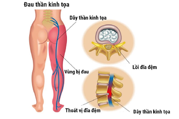 Chữa Bệnh Đau thần kinh tọa
