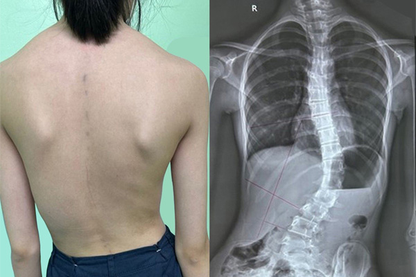 Chữa Bệnh Vẹo cột sống