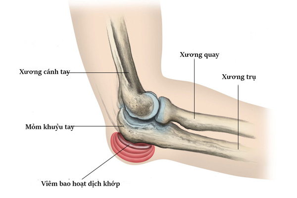 Chữa Bệnh Đau khuỷu tay, Đau cổ tay